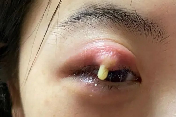 麦粒肿 医学 图片